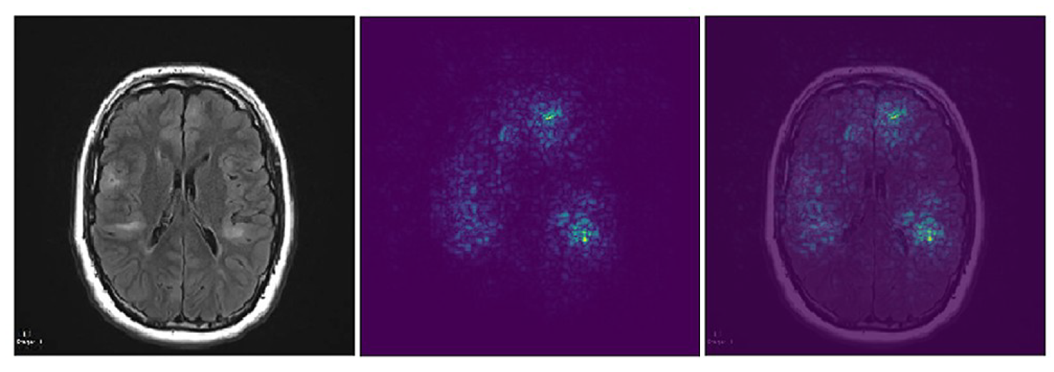 Machine learning and deep learning in rare disorders