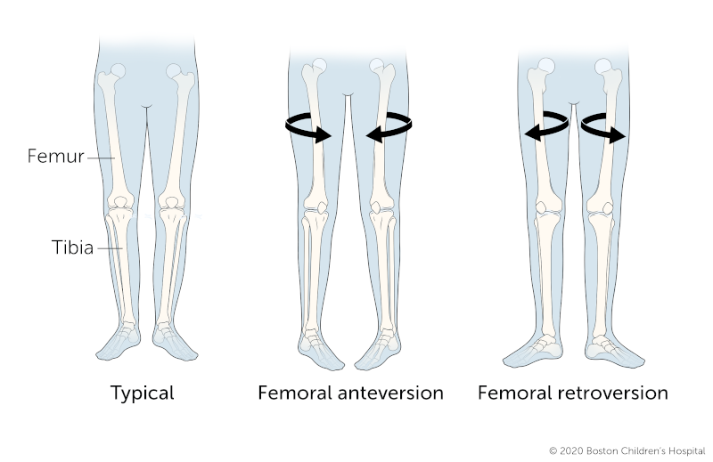 An illustration of typical legs, legs with femoral anteversion, and legs with femoral retroversion.