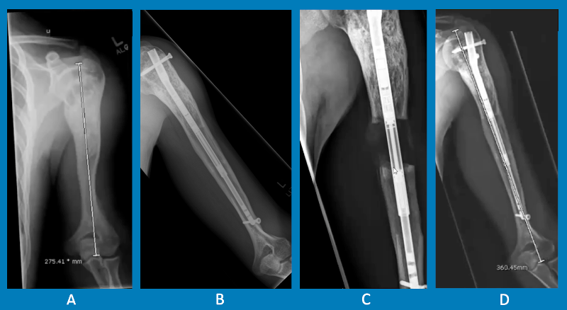 Process of limb lengthening