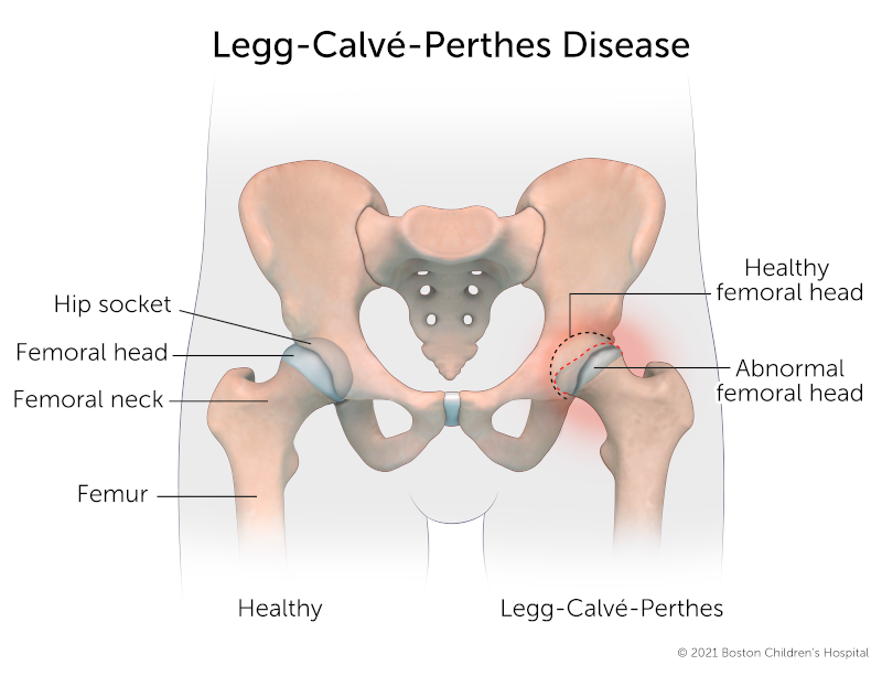 A healthy hip compared to a hip joint with Legg-Calve-Perthes disease. In the healthy hip, the femoral head is round and fits securely into the hip socket. In the hip with Perthes disease, the femoral head has flattened out, and there’s a pocket of empty space in the socket. The surrounding area is red and inflamed.