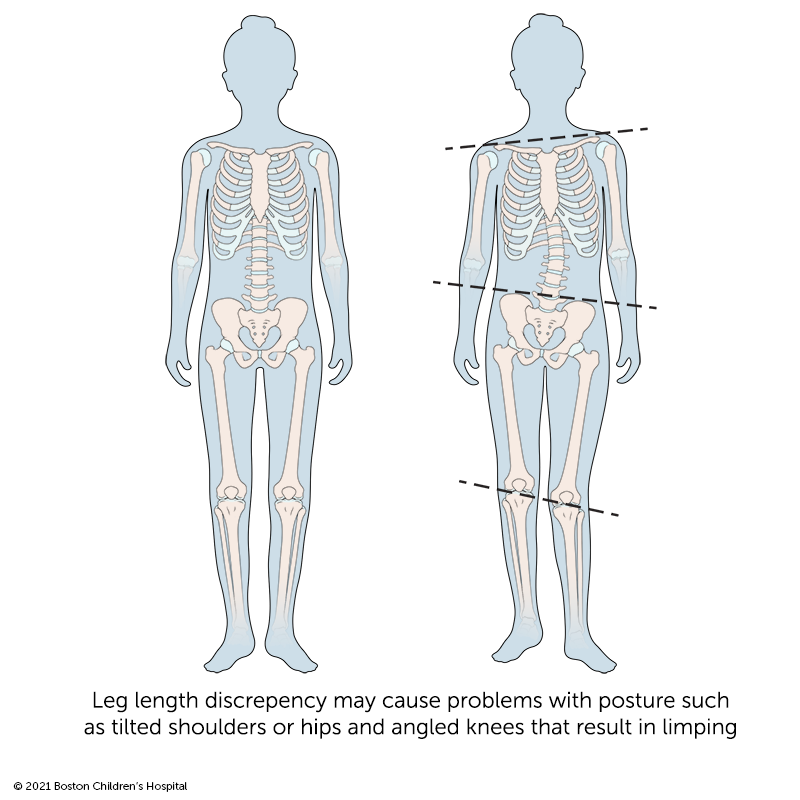 Limb Length Discrepancy  Boston Children's Hospital