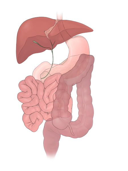 Image of intestinal malrotation and biliary atresia