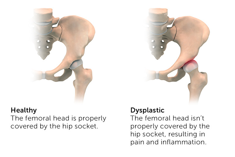 In a healthy hip, the ball-shaped femoral head fits securely into the hip socket. In a hip with hip dysplasia, the femoral head does not fit fully inside the hip socket.