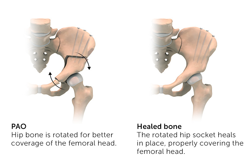 During a PAO procedure, the hip bone is cut and rotated so that it better covers the femoral head. The rotated hip socket heals in place, properly covering the femoral head.