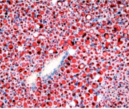 liver cells with a high carbohydrate diet