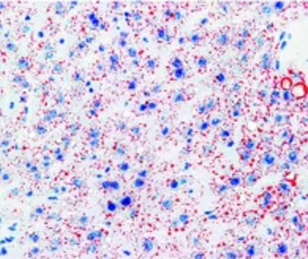 liver cells with a high carbohydrate diet while taking omega 3 fish oil