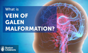 Video card: What is a vein of galen malformation?