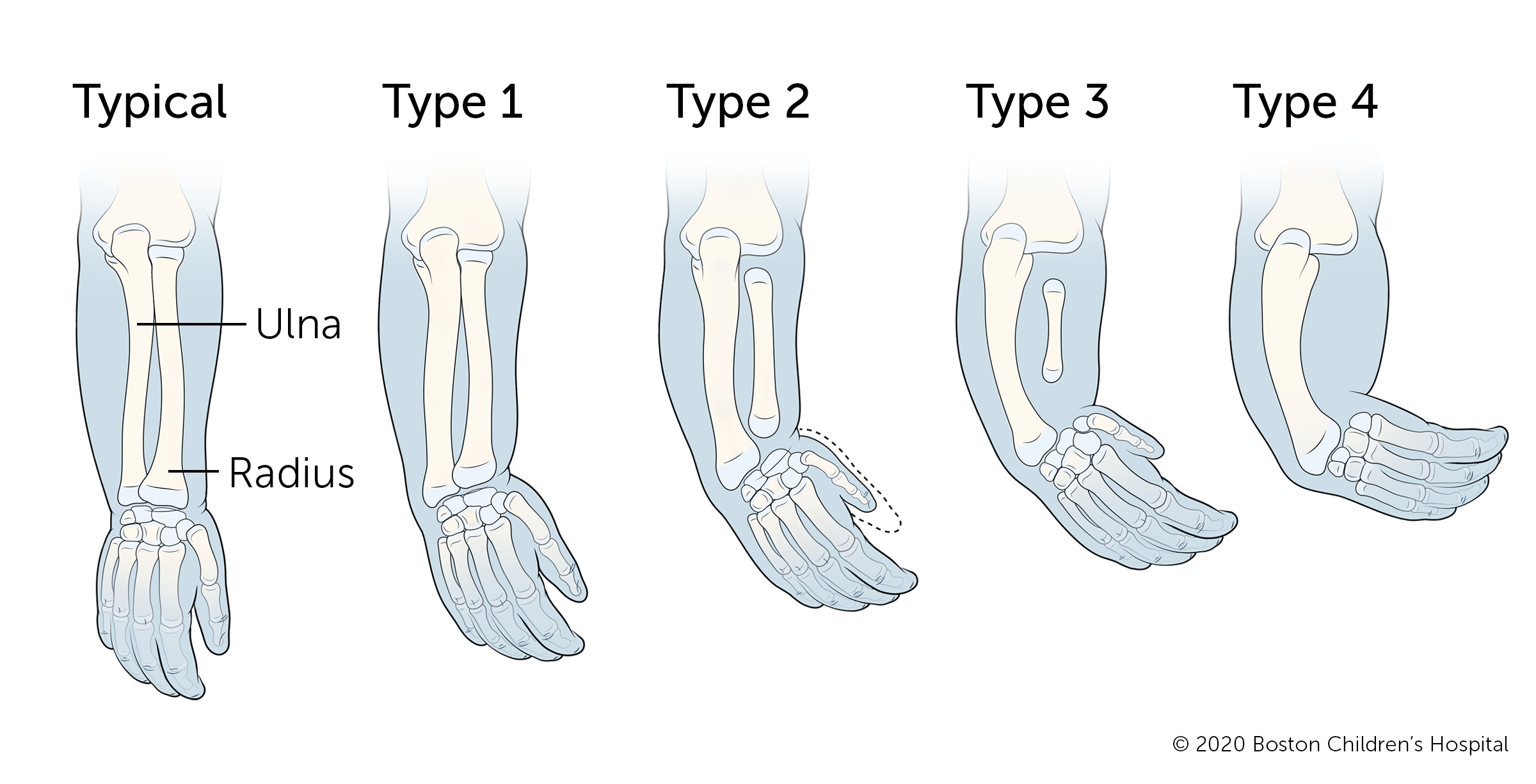 A typical arm compared to four types of radial longitudinal deficiency. Type 1 is the least severe type and type 4 the most severe. In type 1, the radius (the bone on the inside of the forearm) is slightly shorter than the ulna (the bone on the outside of the forearm). In types 2 and 3, the radius is significantly shorter than the ulna and the hand curves inward. In type 4, the ulna is completely missing. The thumb tends to be smaller in more severe types. 