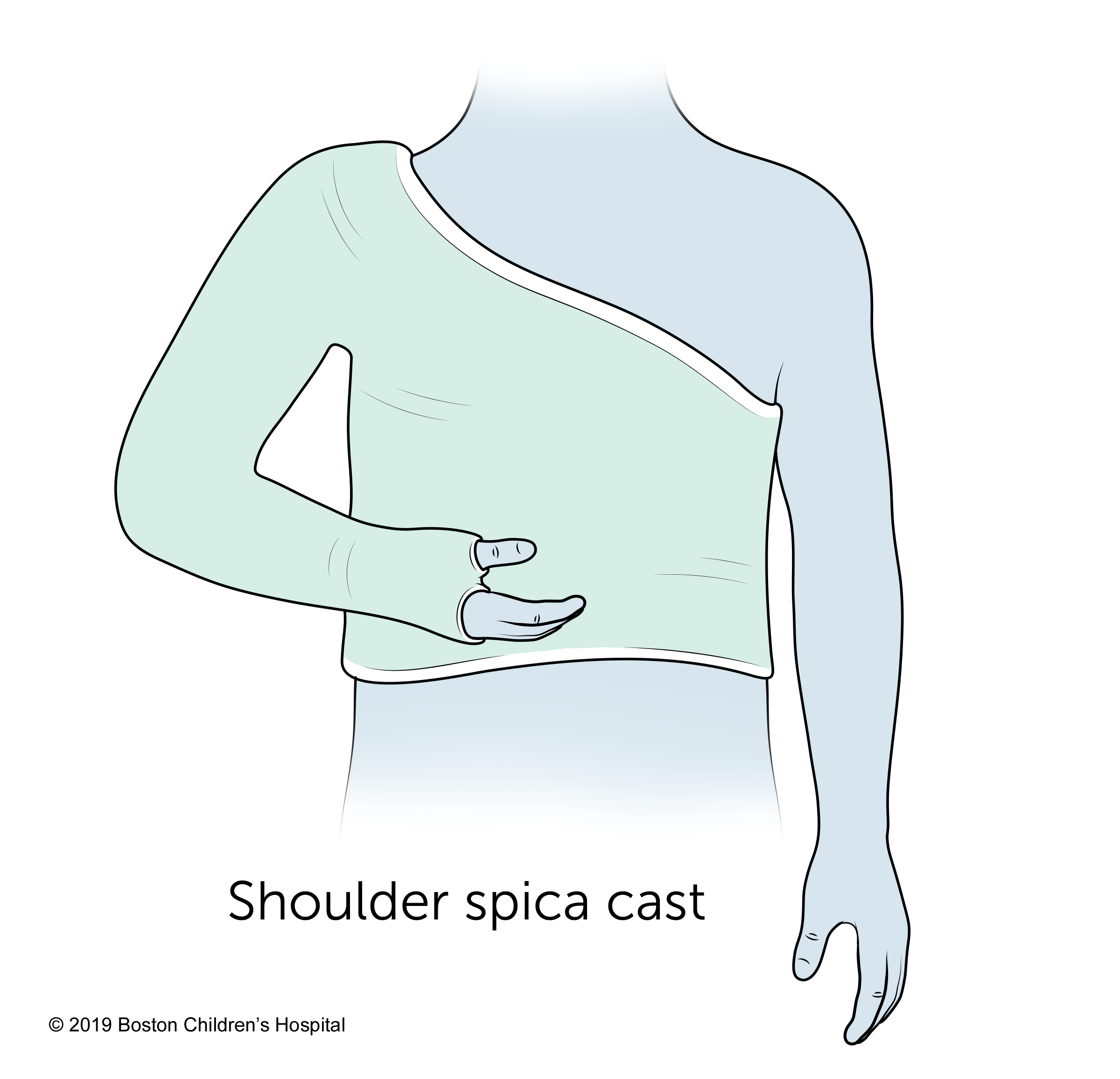 A shoulder spica cast