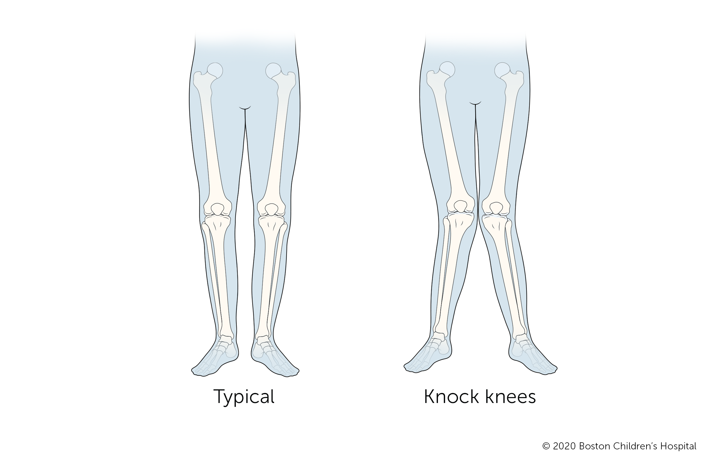 When a child has knock knees, their knees tilt inward while their ankles remain apart.