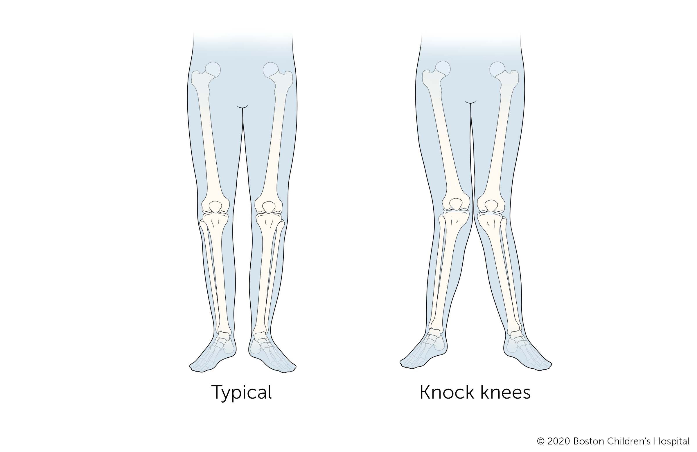 Knock Knees  Boston Children's Hospital