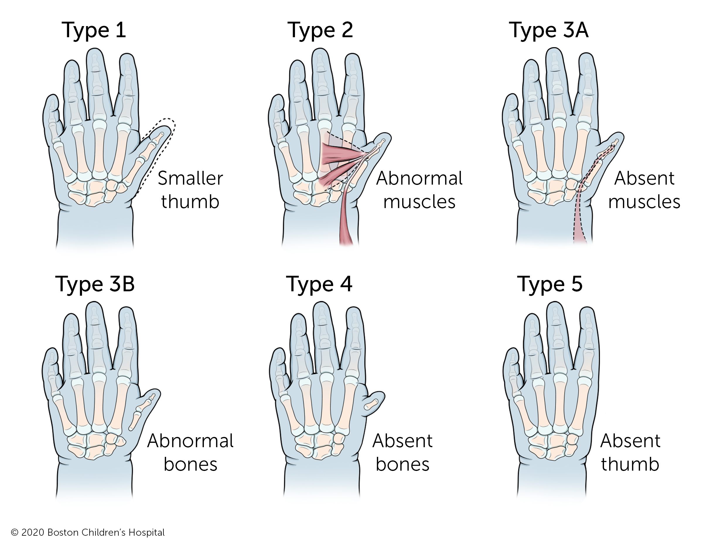 Five types of thumb hypoplasia. In type 1, the thumb is smaller. In type 2, the thumb has abnormal muscles. In type 3A, the muscles of the thumb are absent. In type 3B, the bones of the thumb are abnormal. In type 4, the bones of the thumb are absent. In type 5, the thumb is completely absent.