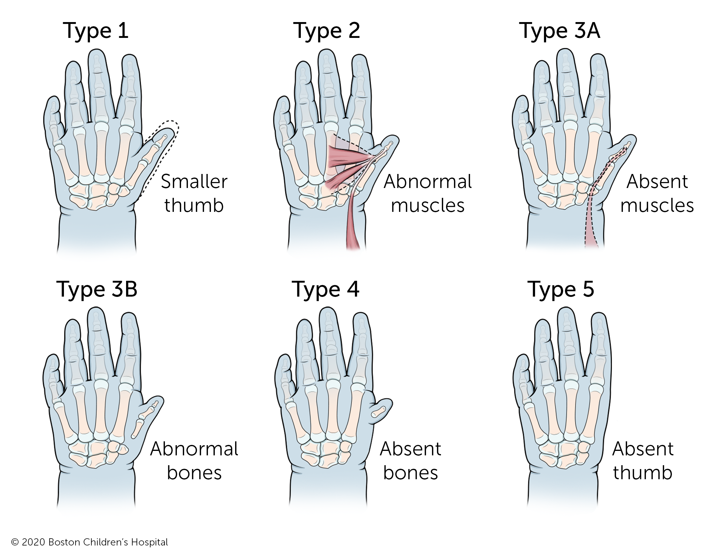 Thumb Hypoplasia and Aplasia Boston Children's Hospital