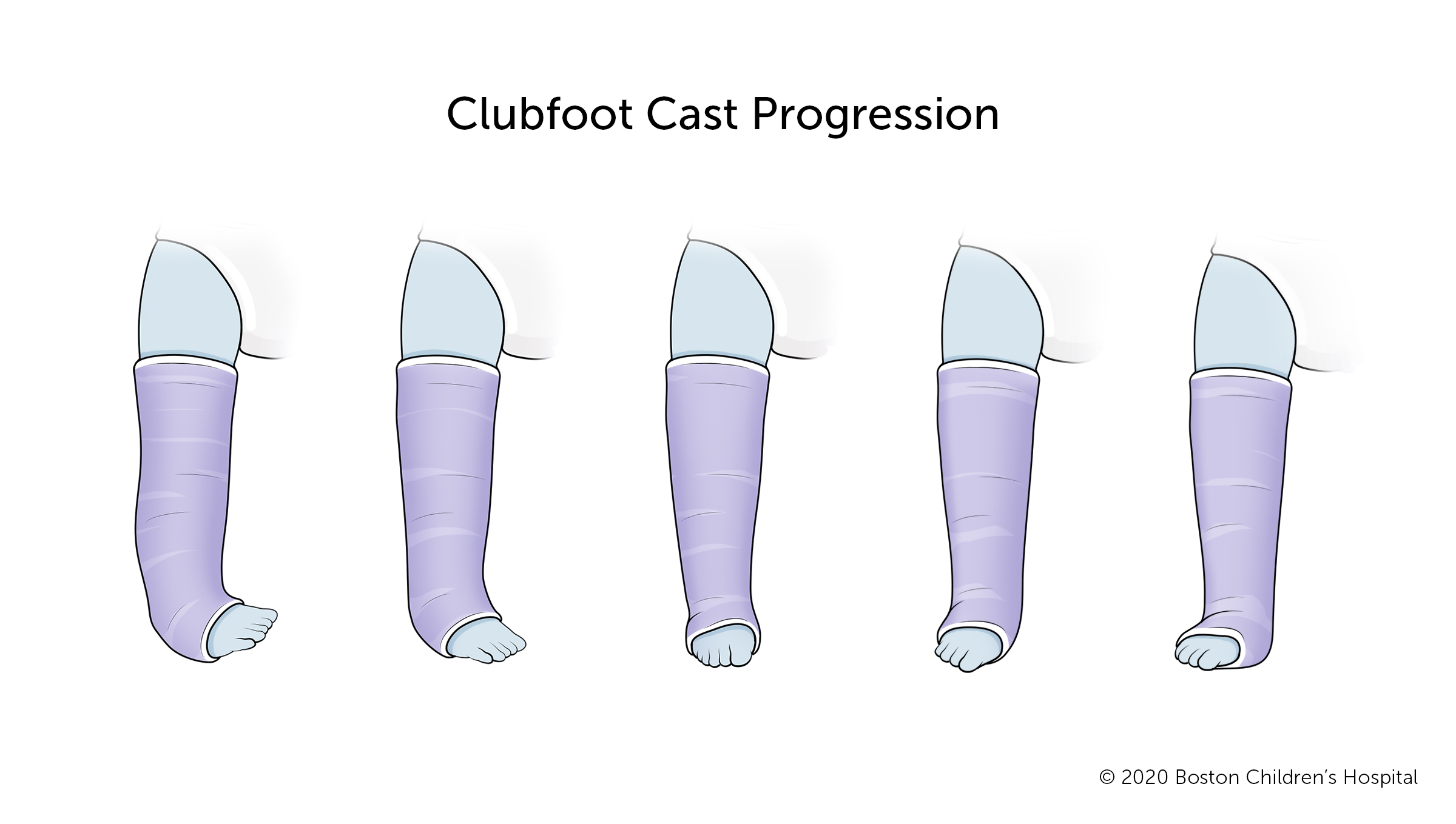 The progression of clubfoot casts.