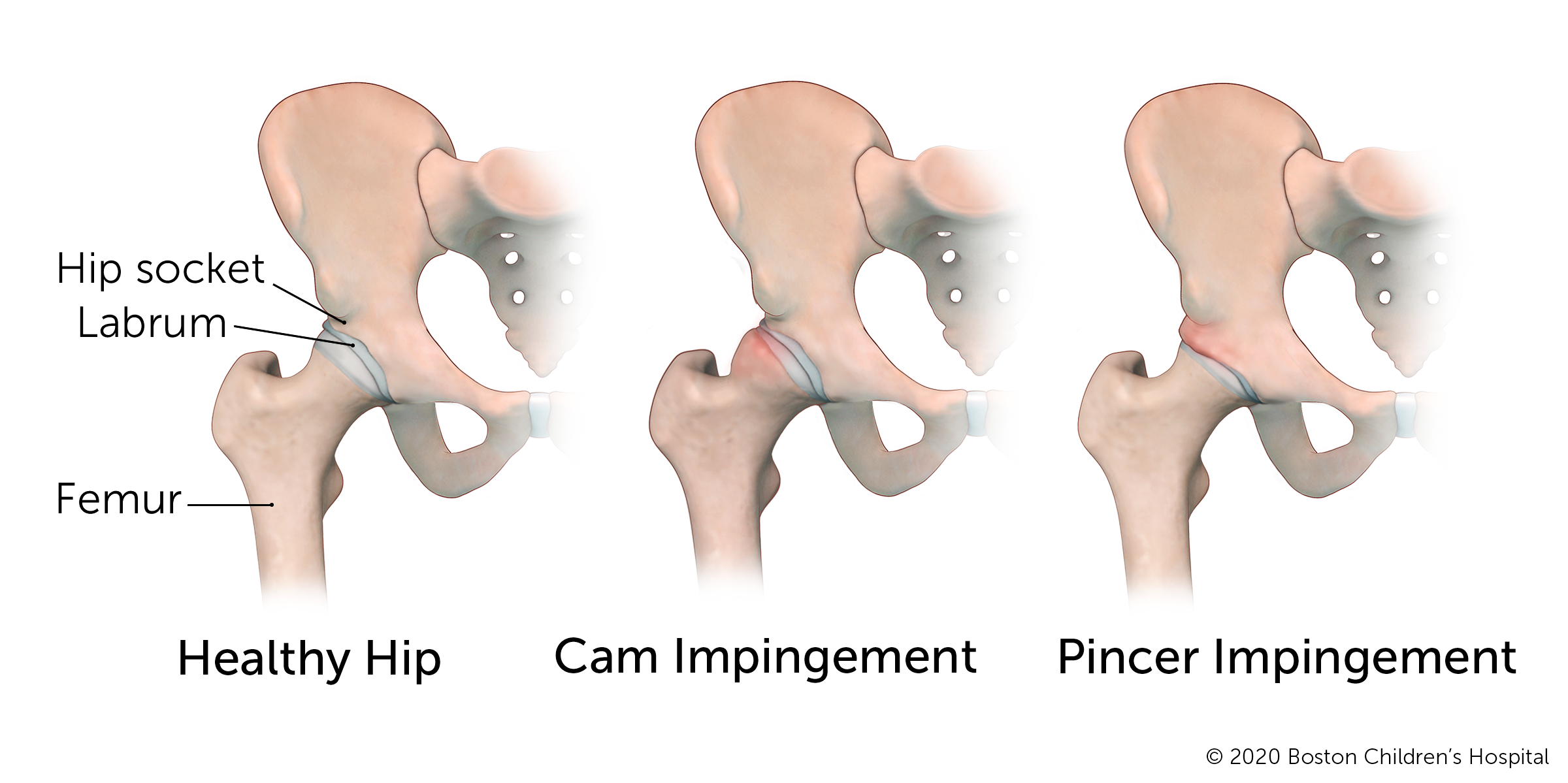 Perseus ambulance affældige Hip Impingement | Boston Children's Hospital