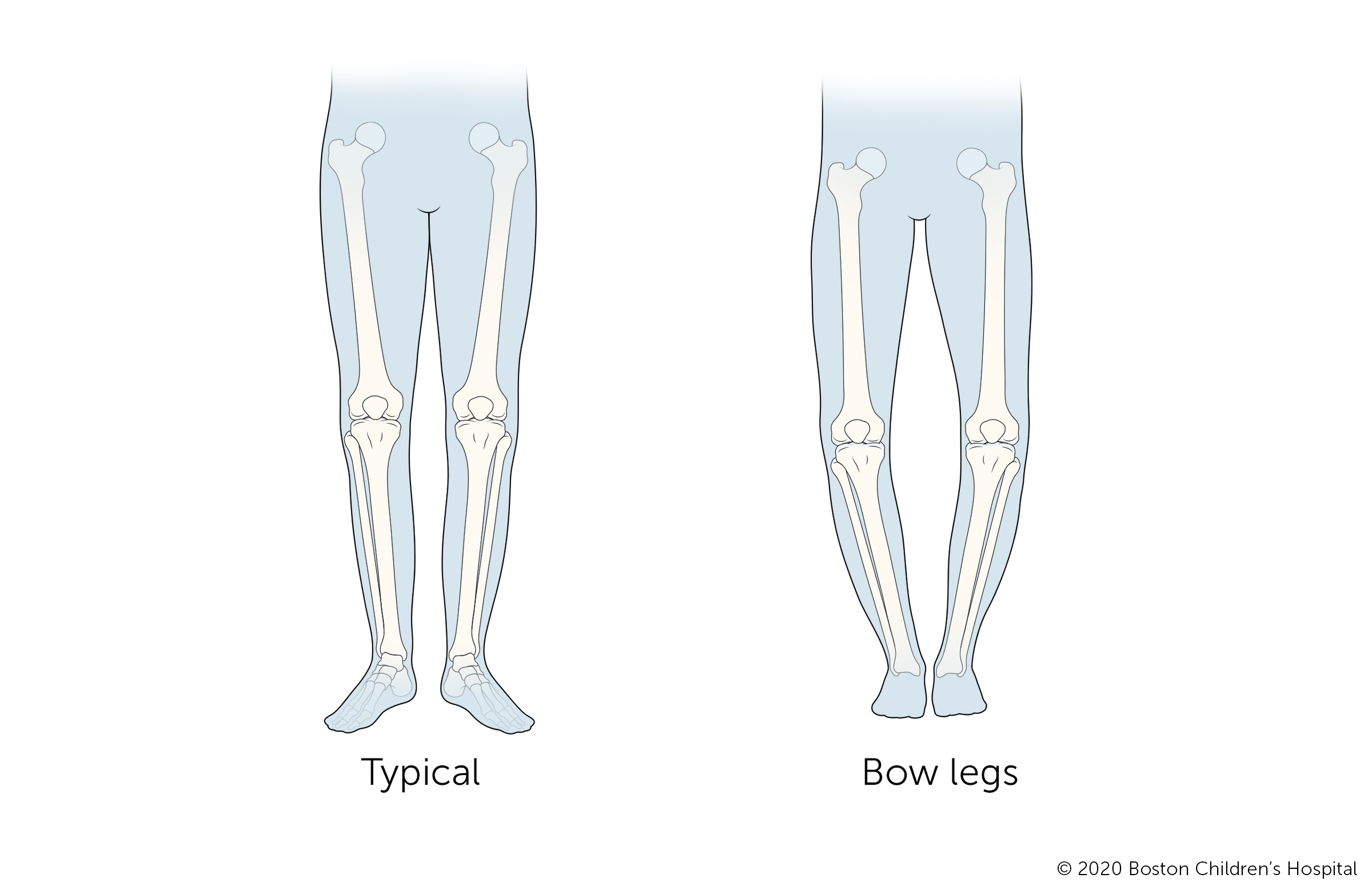 On the left is a child with typical development. On the right is a child who has bow legs.