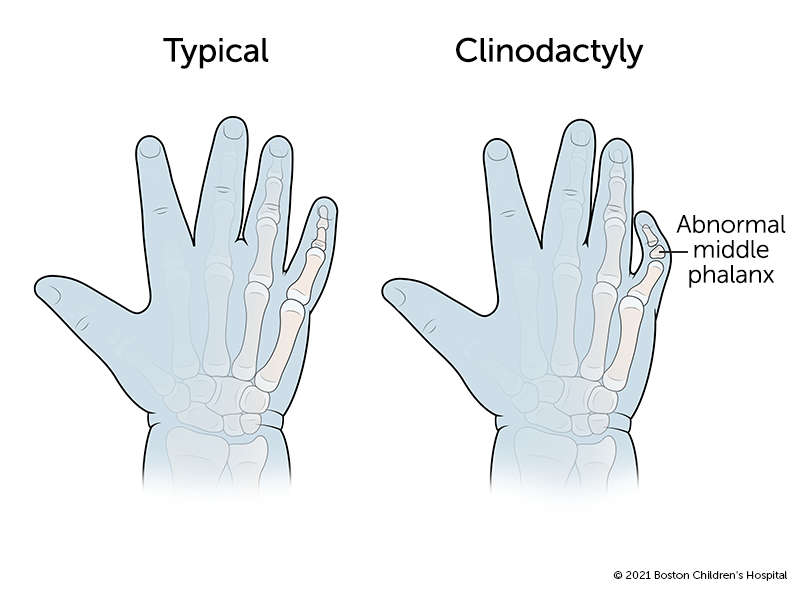 In a finger with clinodactyly, the middle bone (phalanx) has a triangular shape that causes the finger to curve abnormally to one side.