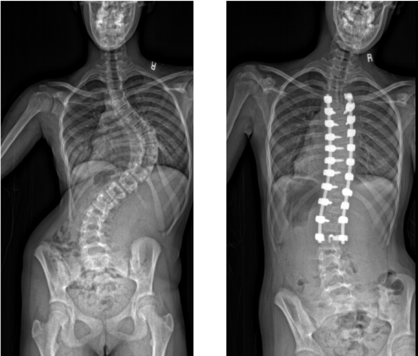  X-rays of spine pre- and post-surgery with Mazor X