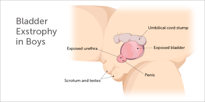 Image: Bladder exstropy in boys