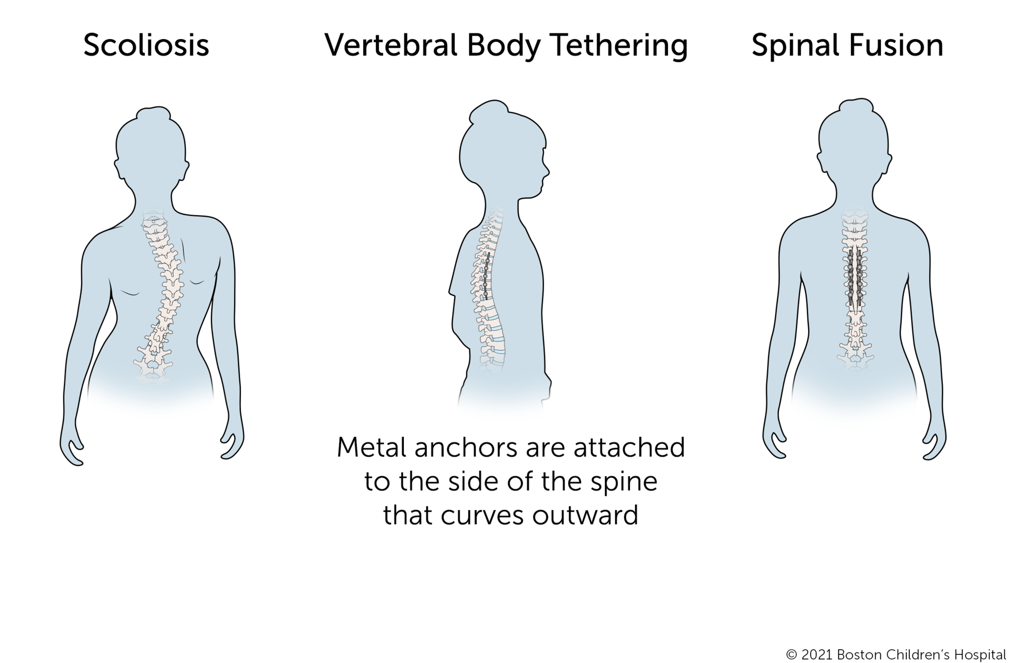 Vertebral body tethering is a new procedure for mild scoliosis. Metal anchors and a flexible tether are attached to the side of the spine that curves outward. By comparison, for spinal fusion surgery, metal anchors and stiff rods are attached to both sides of the spine.
