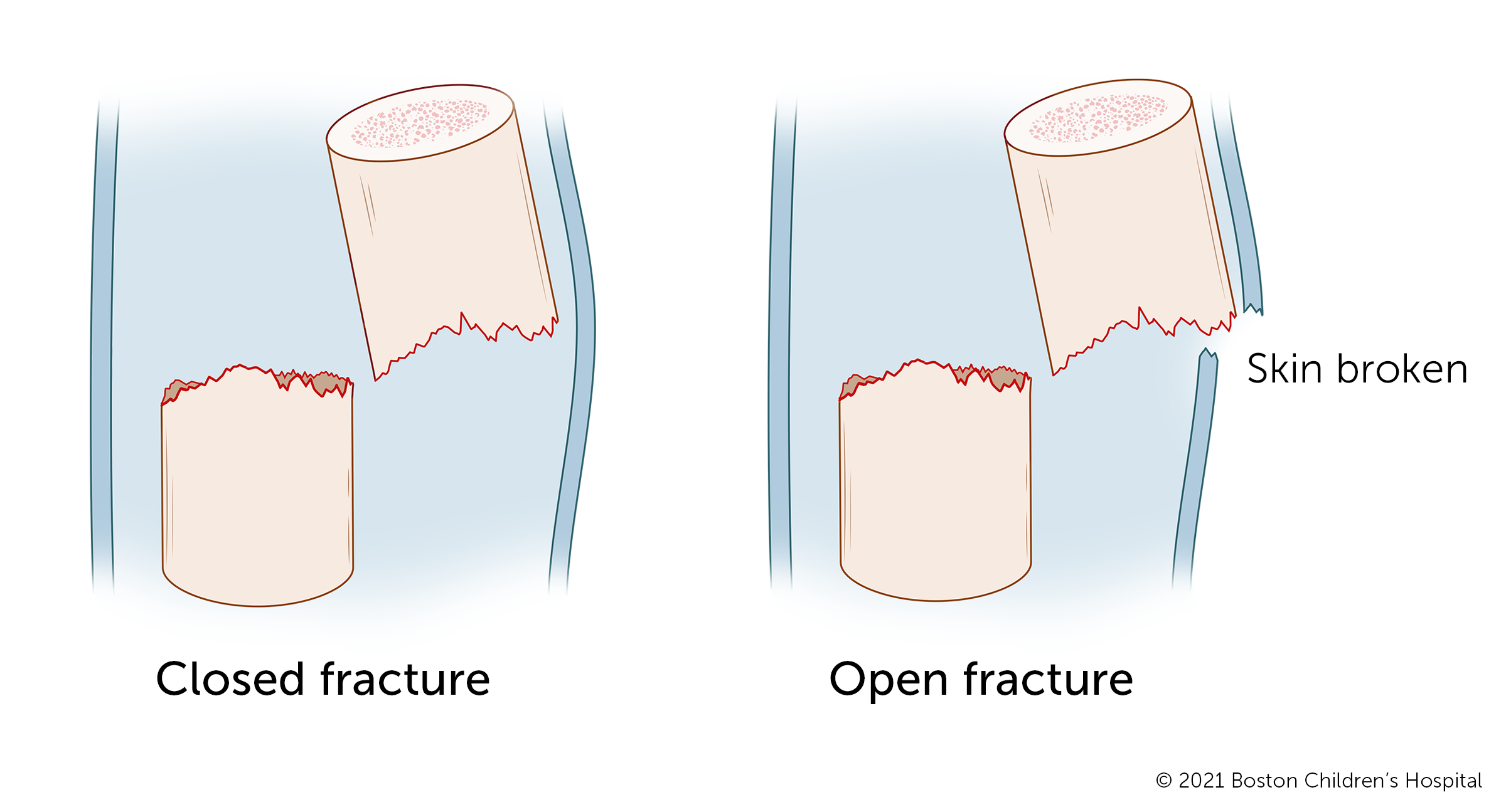 An illustration of open and closed fractures