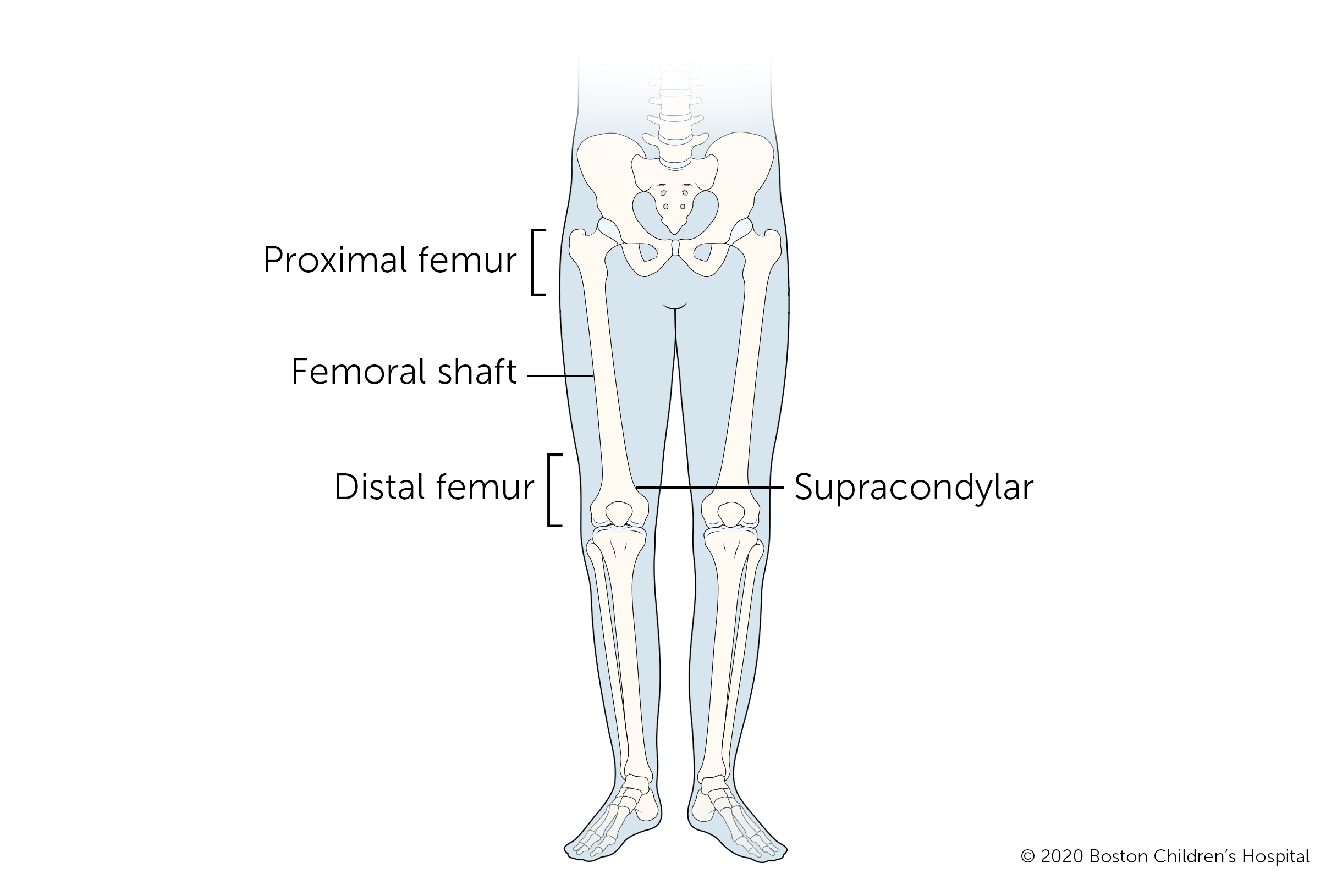 The four types of leg fractures (broken femurs) are proximal femur, femoral shaft, supracondylar femur, and distal femur.