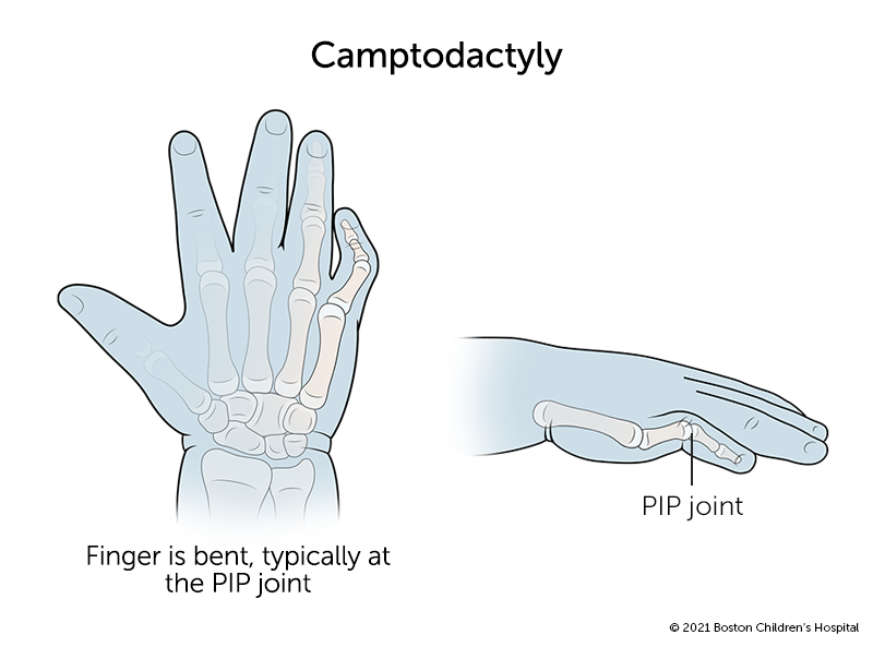 Abnormal Finger shape and pick grip - Playing Technique - The Cracking the  Code Forum