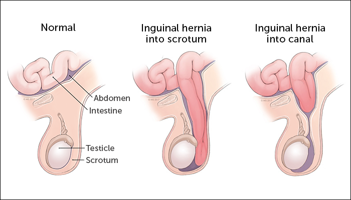 Hérnia inguinal