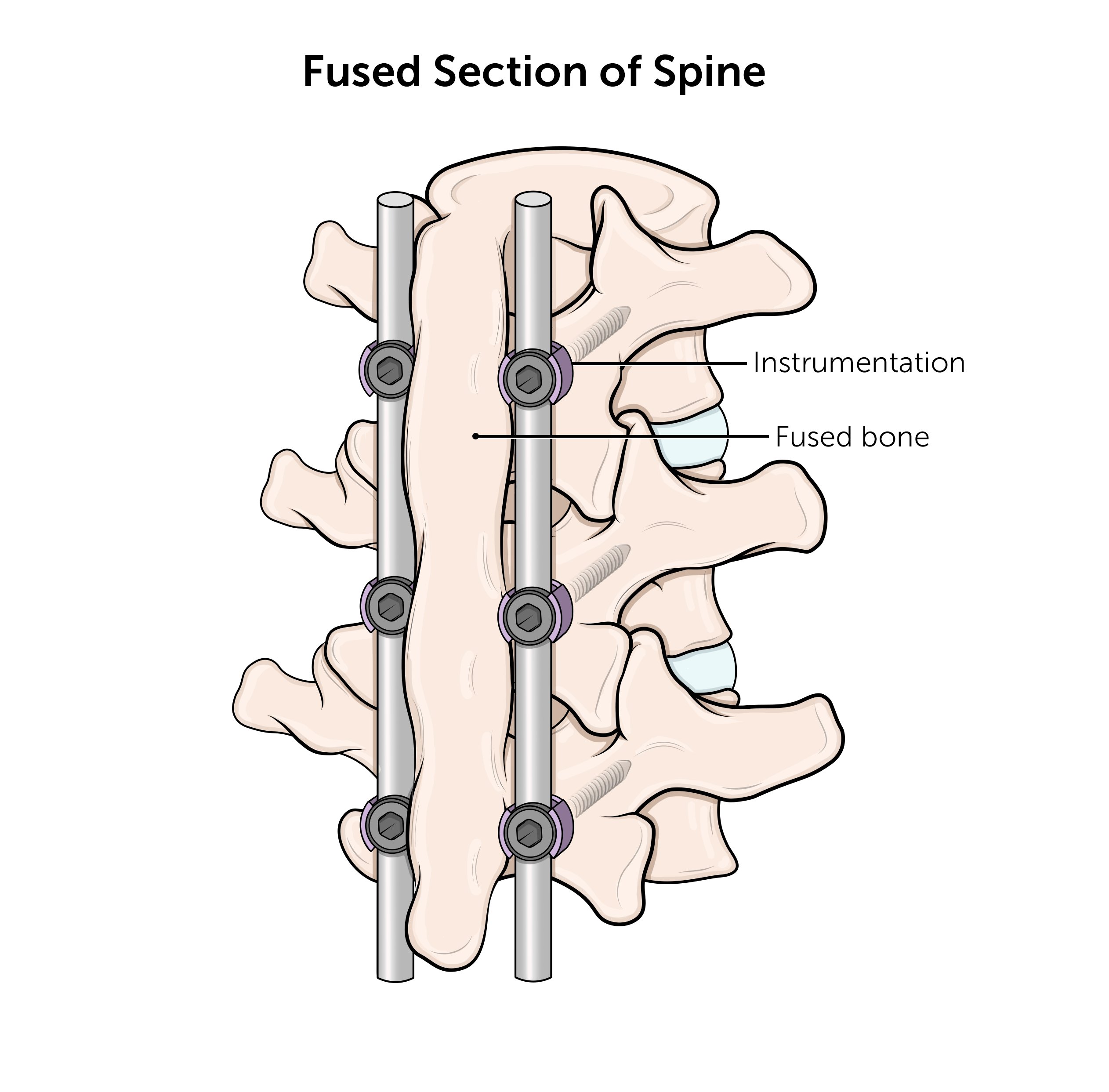 Fused bone after spinal fusion surgery. 