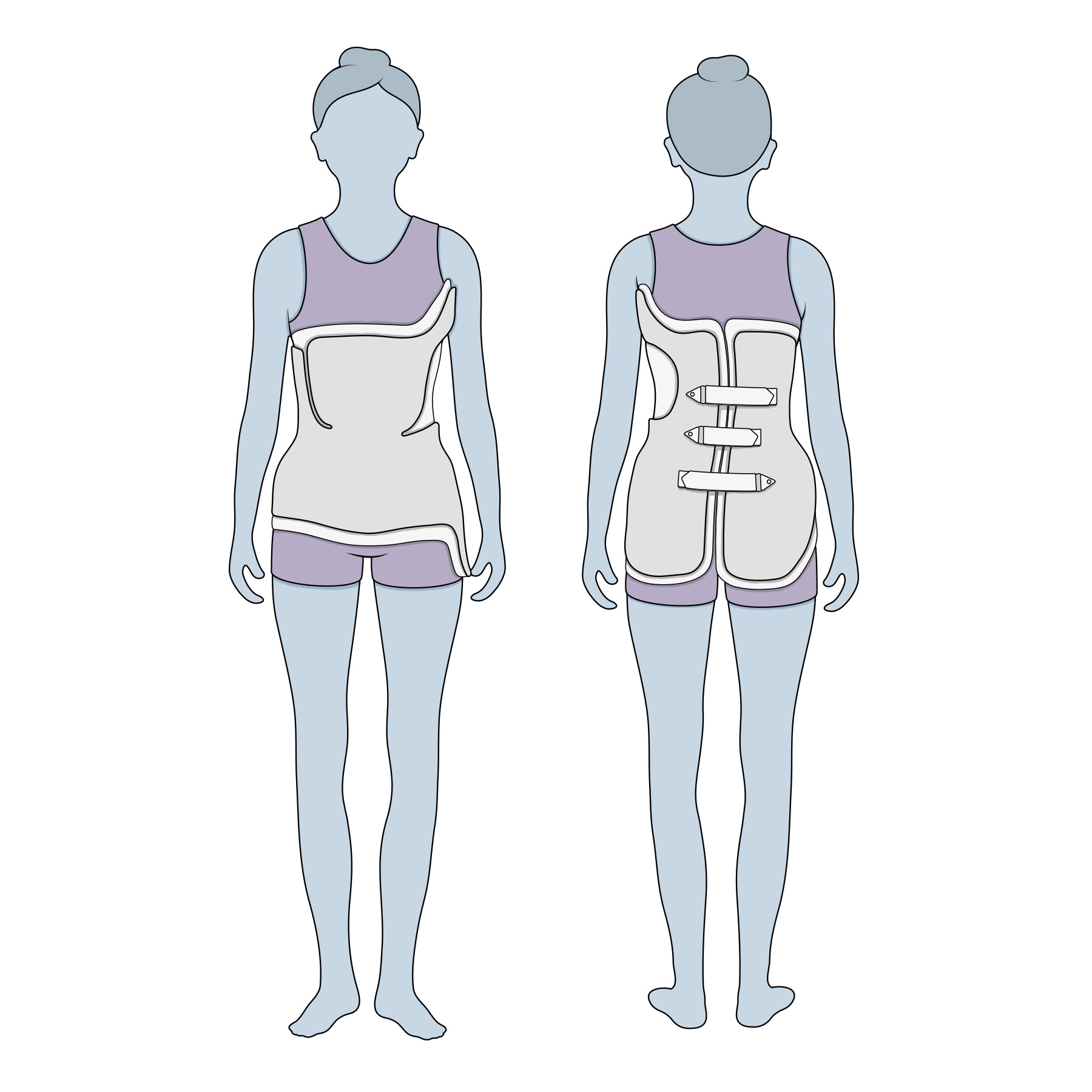 Illustration of scoliosis bracing treatment.