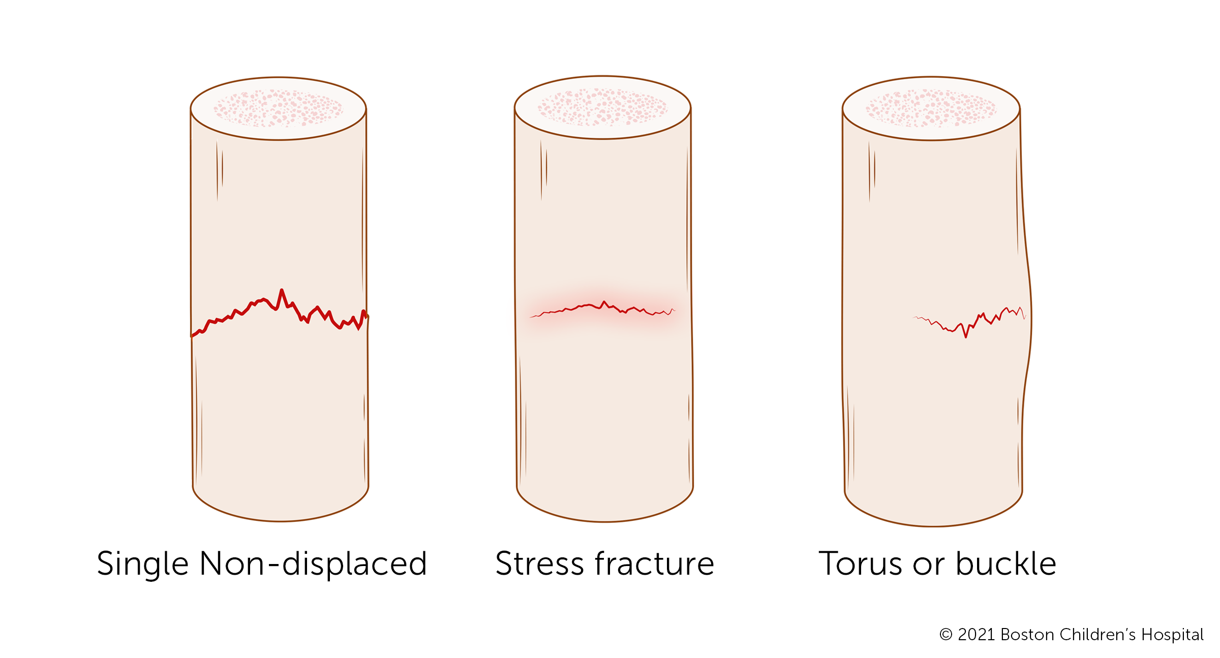 An illustration of non-displaced fractures