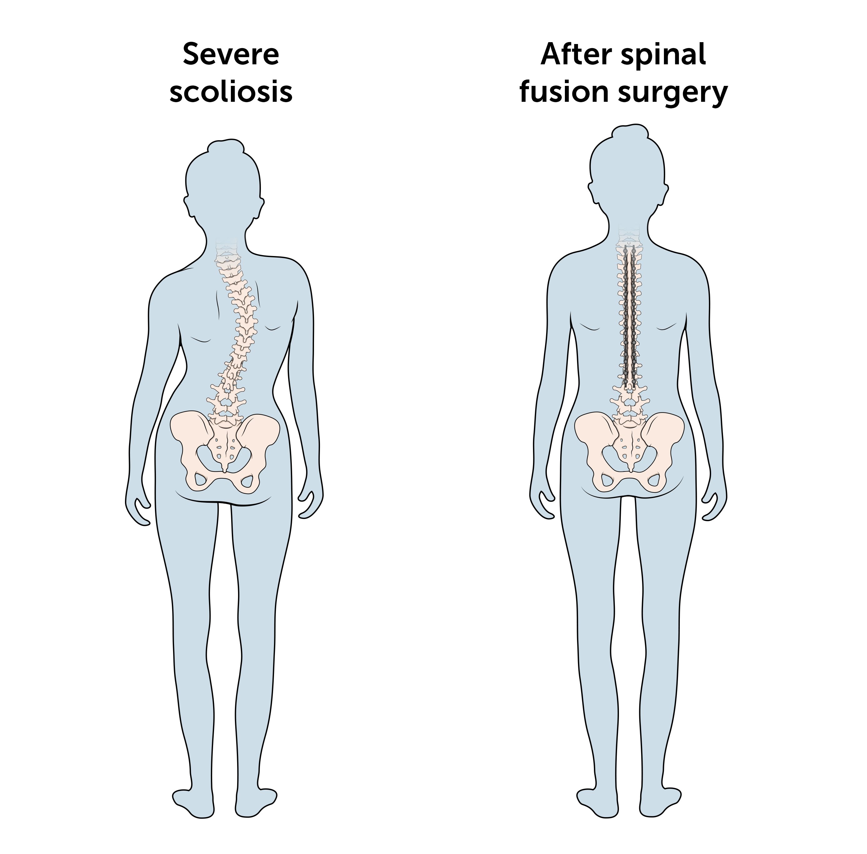 Illustration of patient with severe scoliosis before and after spinal fusion surgery. 