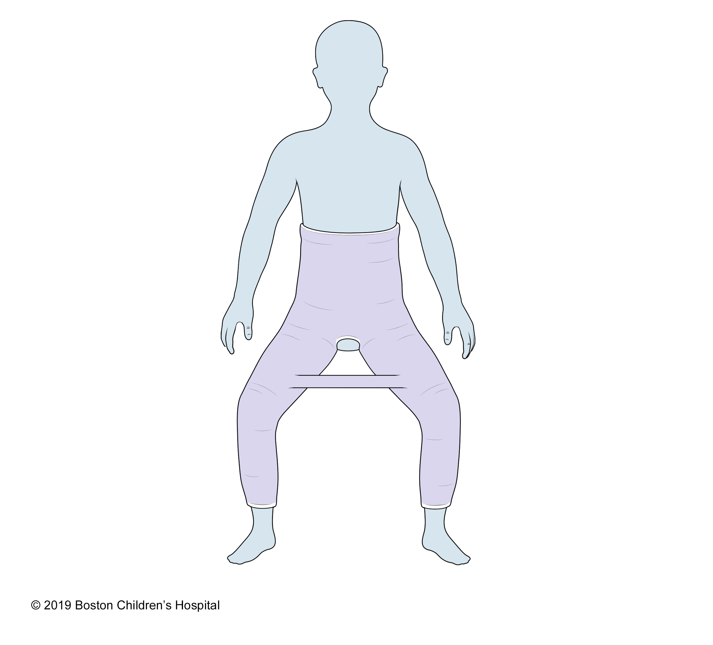 A bilateral long leg hip spica cast (also known as a double hip spica cast)