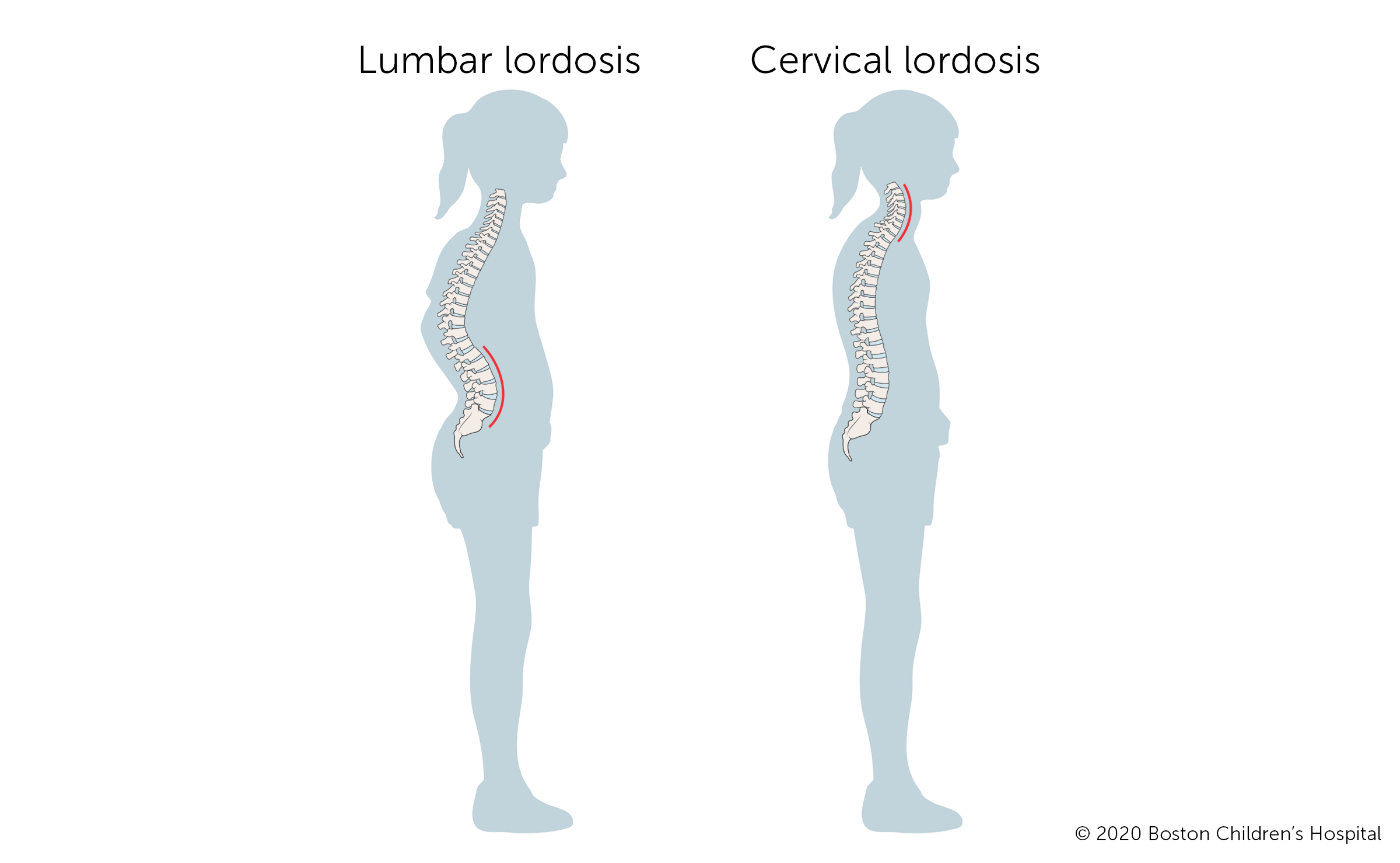 Image: How lumbar lordosis looks compared to cervical lordosis.