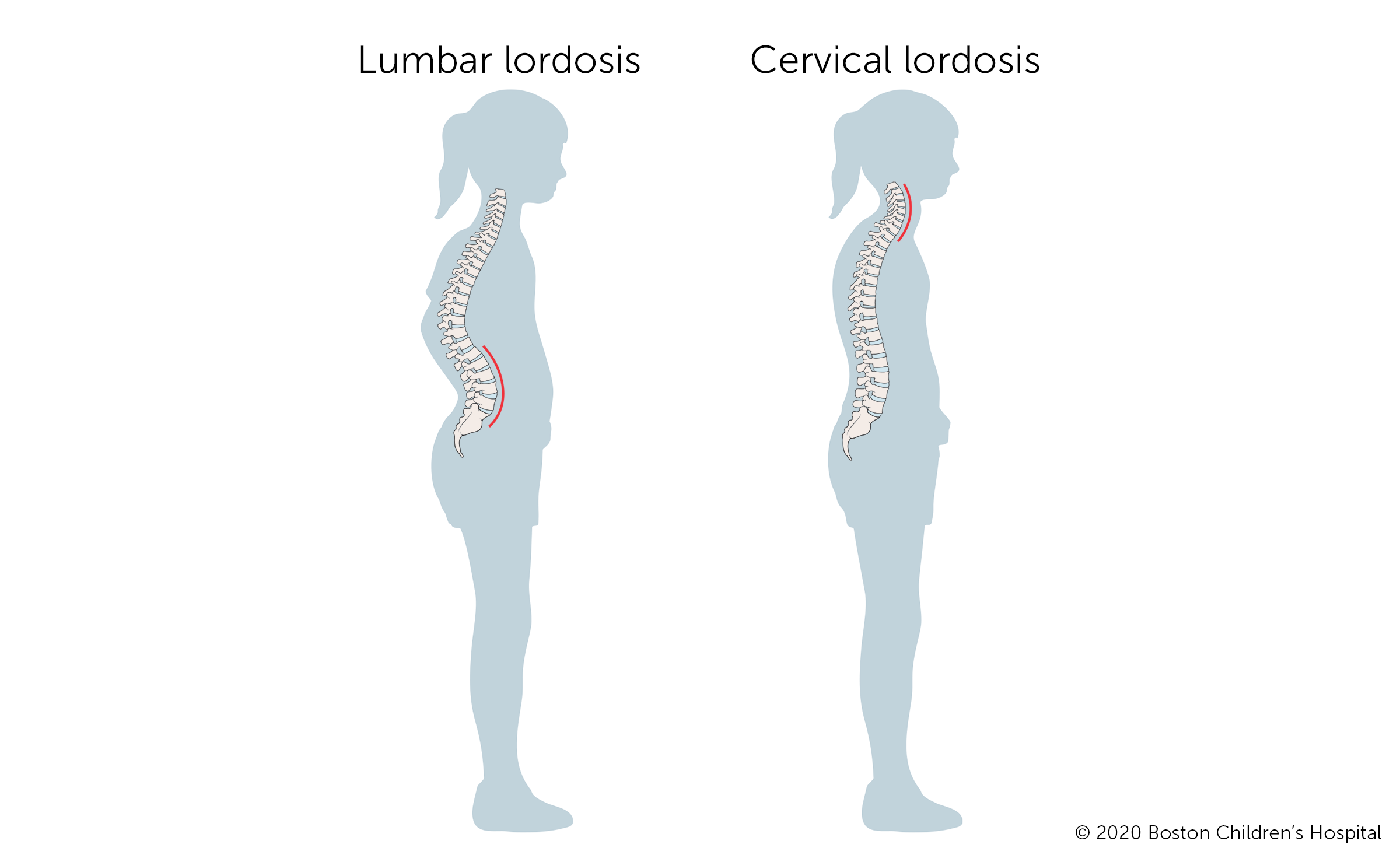 Lordosis Boston Children s Hospital