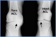 Torn ACL versus Intact ACL