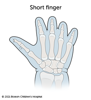 Image of short finger symbrachydactyly