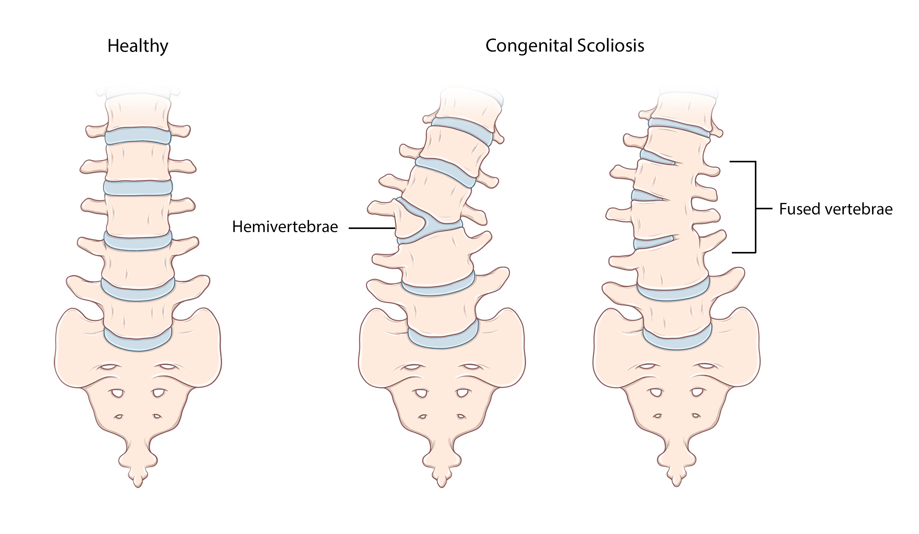 Congenital scoliosis occurs early in pregnancy, when one or more of the vertebrae in the spine don’t form completely.