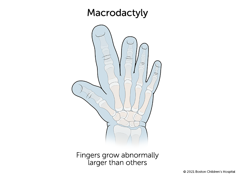 A hand with macrodactyly in which two fingers have grown abnormally large.