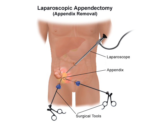 Appendix Appendix Pain?