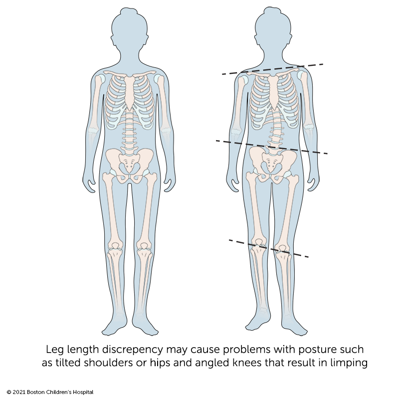 Leg-length discrepancy may cause problems with posture, such as tiled shoulders or hips and angled knees.