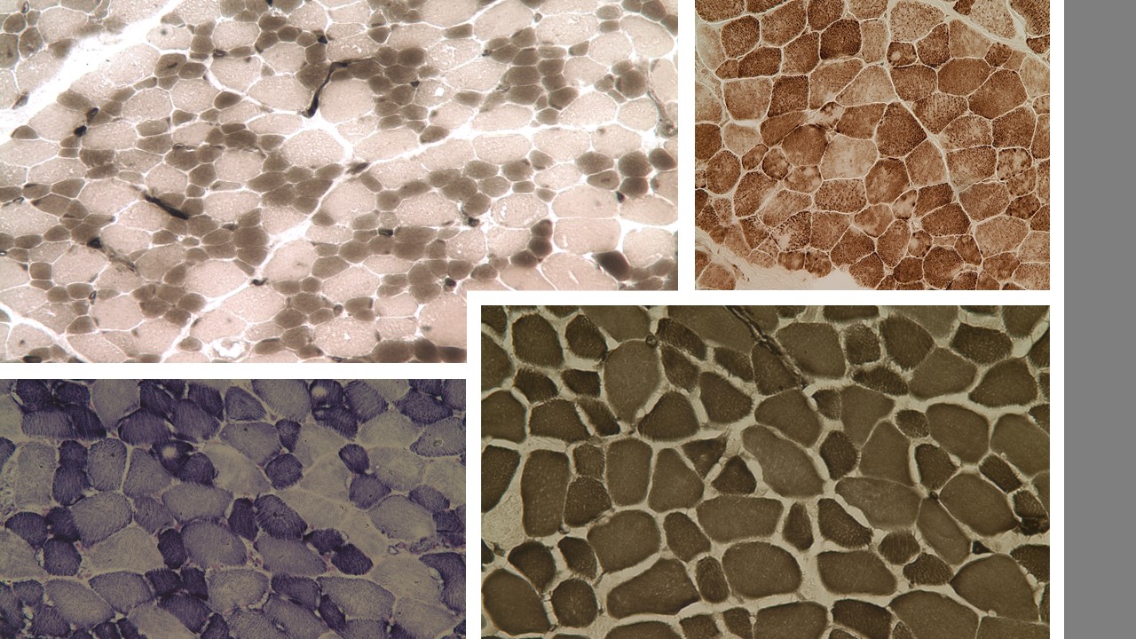 Various muscle cells exhibiting different pathological findings that all fall under the umbrella term of SELENON Related Myopathies; top left: CFTD; top right: Multiminicore myopathy; bottom left: areas lacking mitochondria (light spots in the dark purple cells);  bottom right: CFTD.