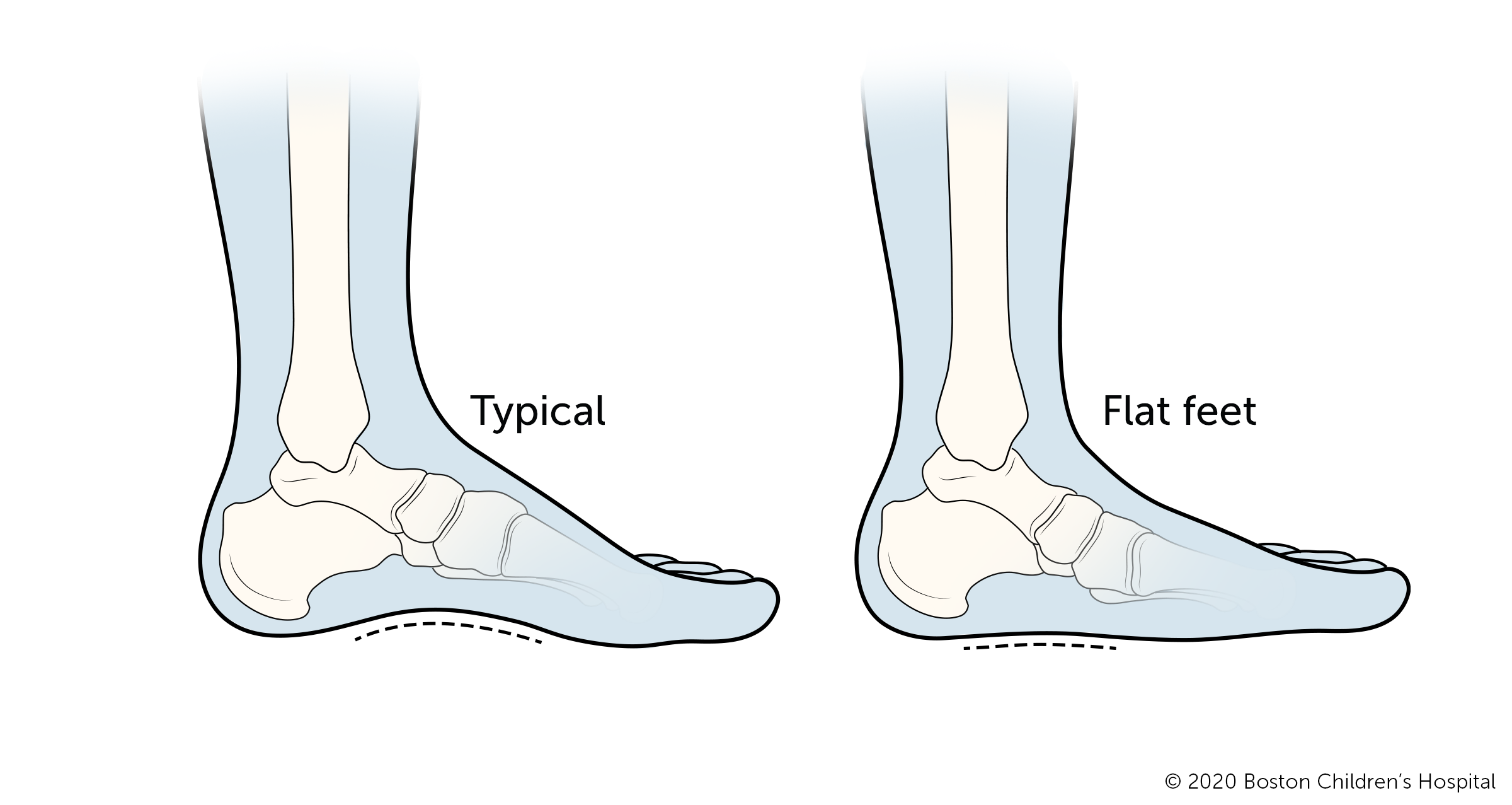 Walking (Gait) Abnormalities | Boston Children's Hospital