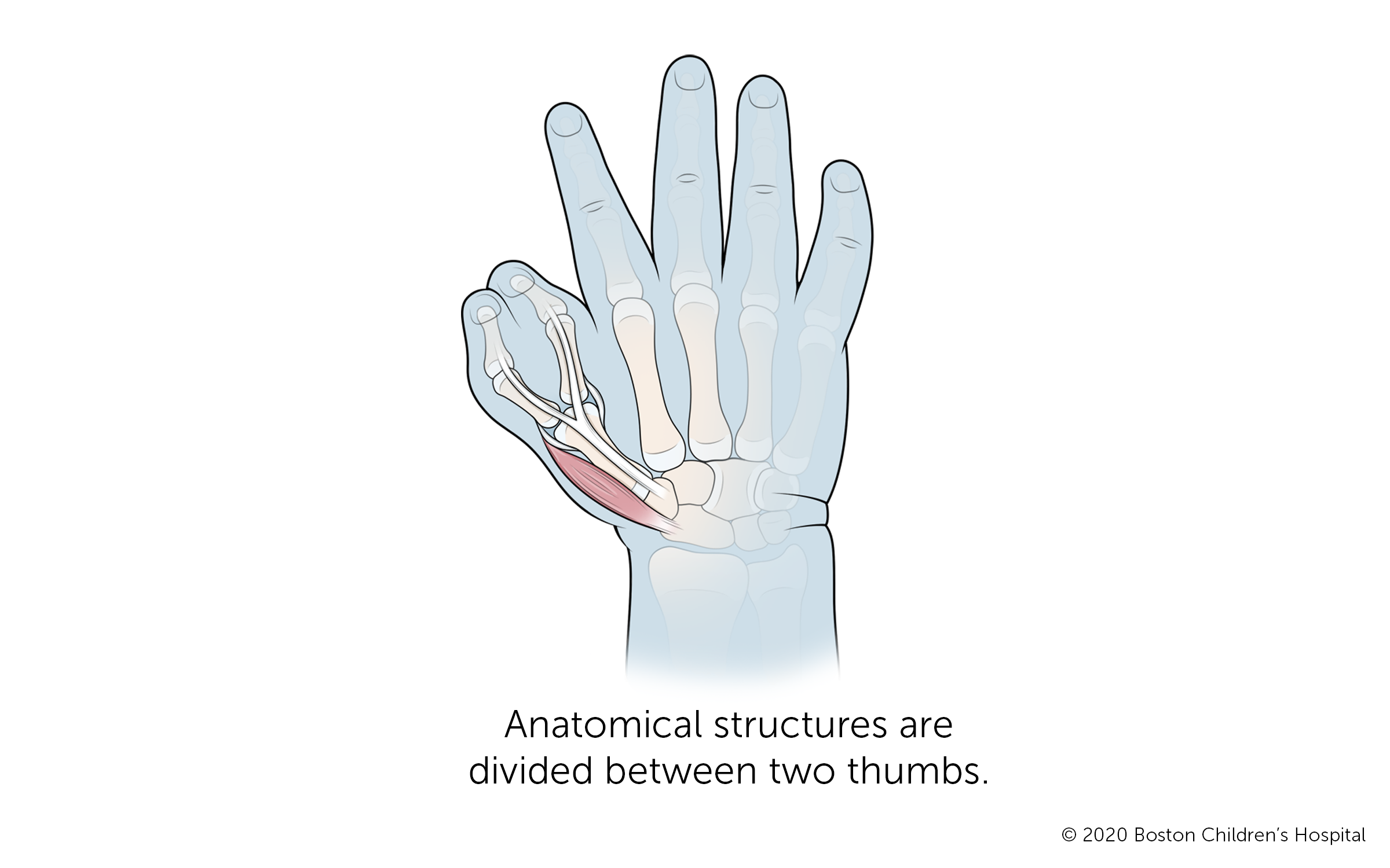 A hand with a duplicate thumb in which the anatomical structures are divided between two thumbs. The thumb bone branches out at the thumb joint into two bones connected by skin.