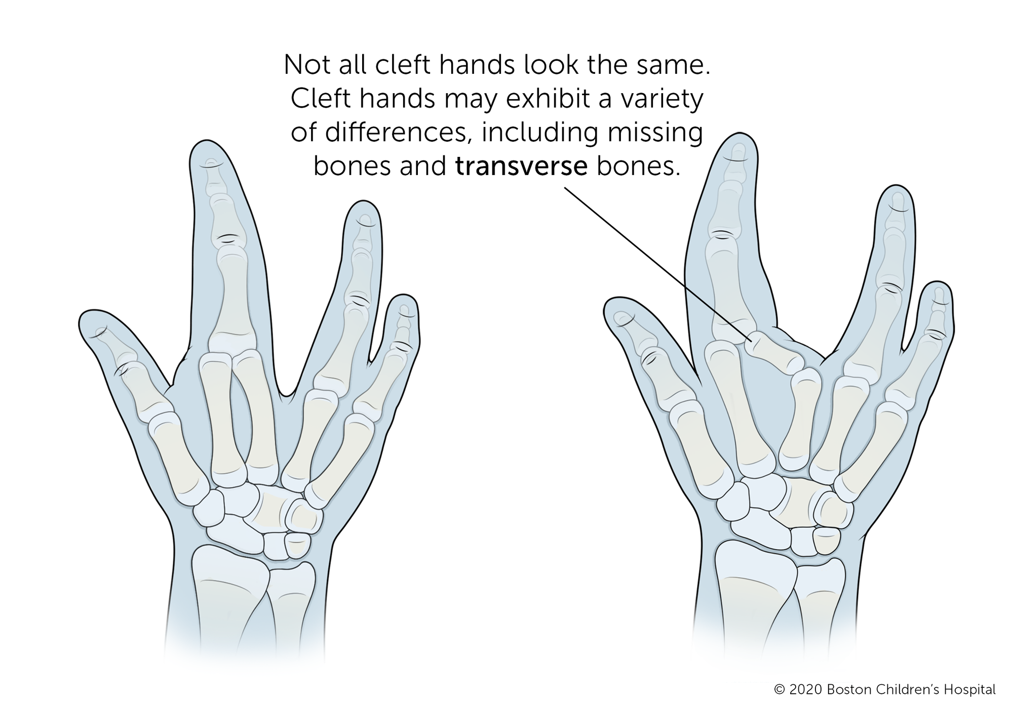 Typically, a cleft hand is missing a finger or fingers in the middle of the hand and has a pronounced V-shaped cleft in that space. But not all cleft hands look the same. Cleft hands may exhibit a variety of differences such as missing bones and transverse bones. In some cases, the cleft occurs on the thumb side or pinkie side of the hand.