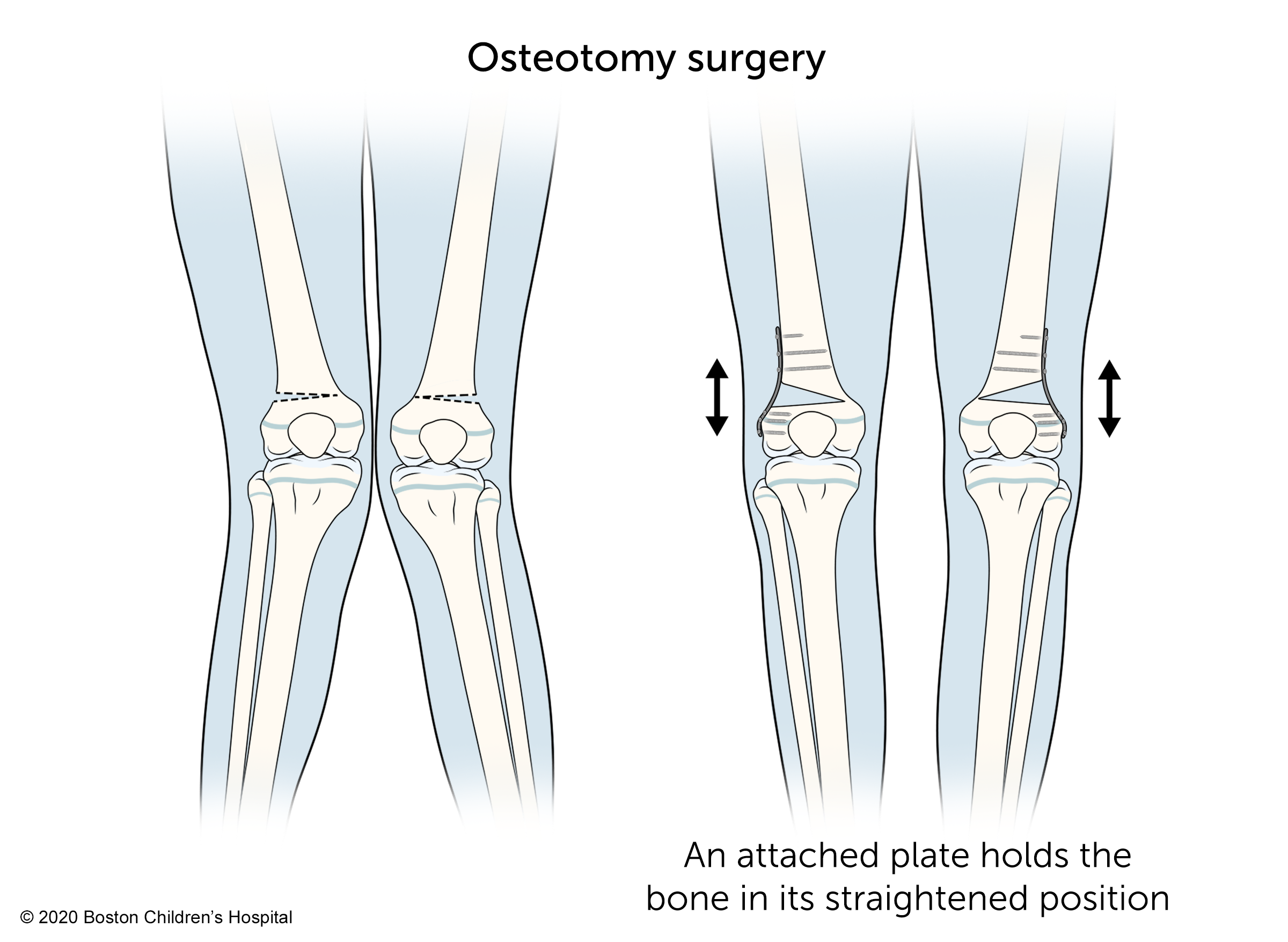 In osteotomy surgery, an attached plate holds the bone in its straightened position.