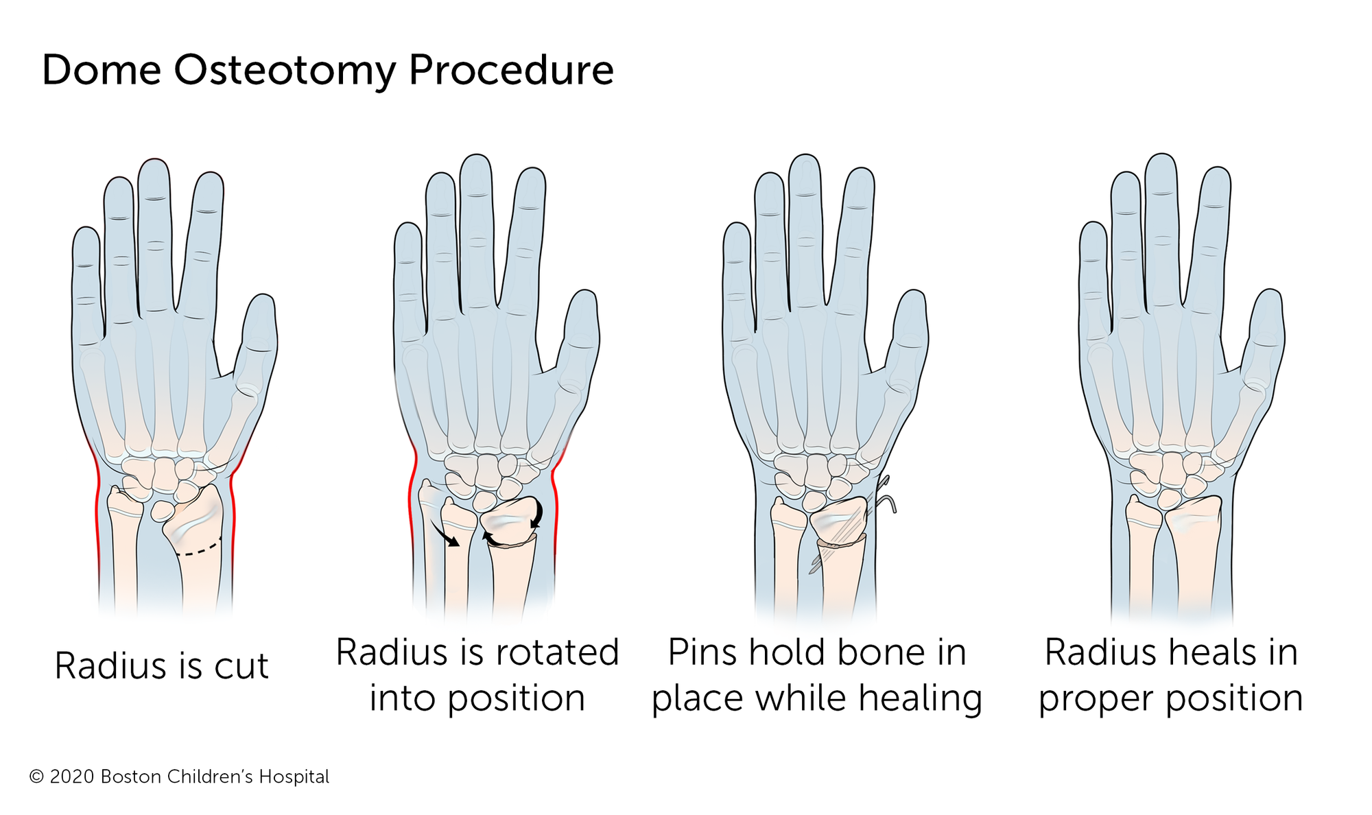 A dome osteotomy procedure corrects Madelung’s deformity by cutting the radius above where it connects to the wrist. The bone is then rotated and held in place with pins while it heals.