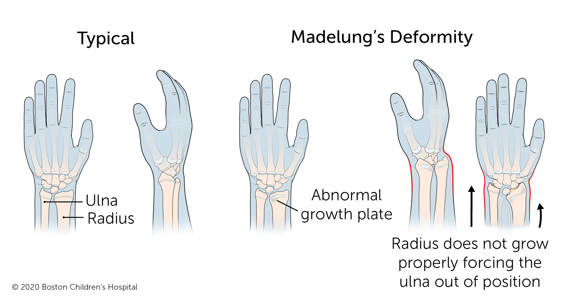 In a typical arm, the two long bones of the forearm (the ulna and the radius) connect to the wrist in a smooth line. With Madelung’s deformity, the radius grows abnormally, forcing the ulna out of position.