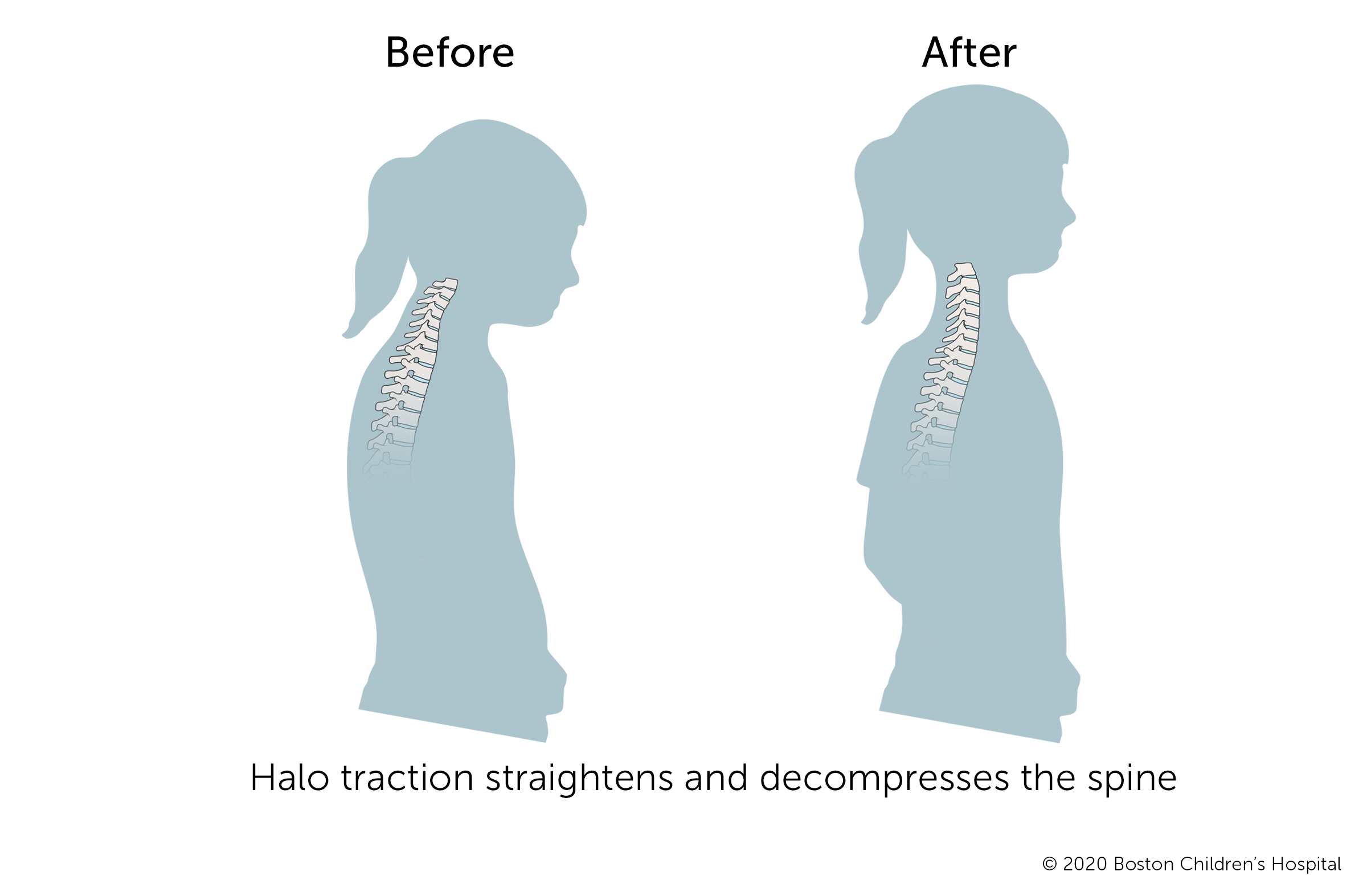 Halo traction is used to decompress the cervical spine. A child’s neck becomes visibly longer.