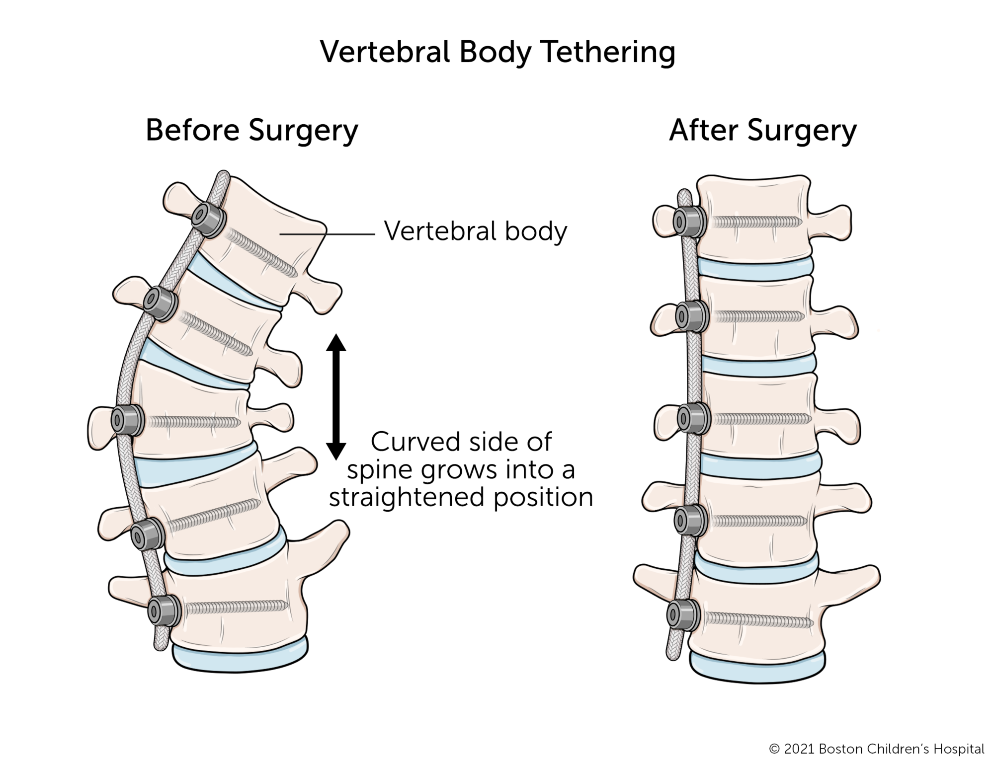 A before and after illustration of vertebral body tethering. Before the surgery, several vertebrae are shorter on one side than the other. After surgery to attach the tether to the curved side of the spine, the vertebrae grow into even shapes and the spine becomes straighter.
